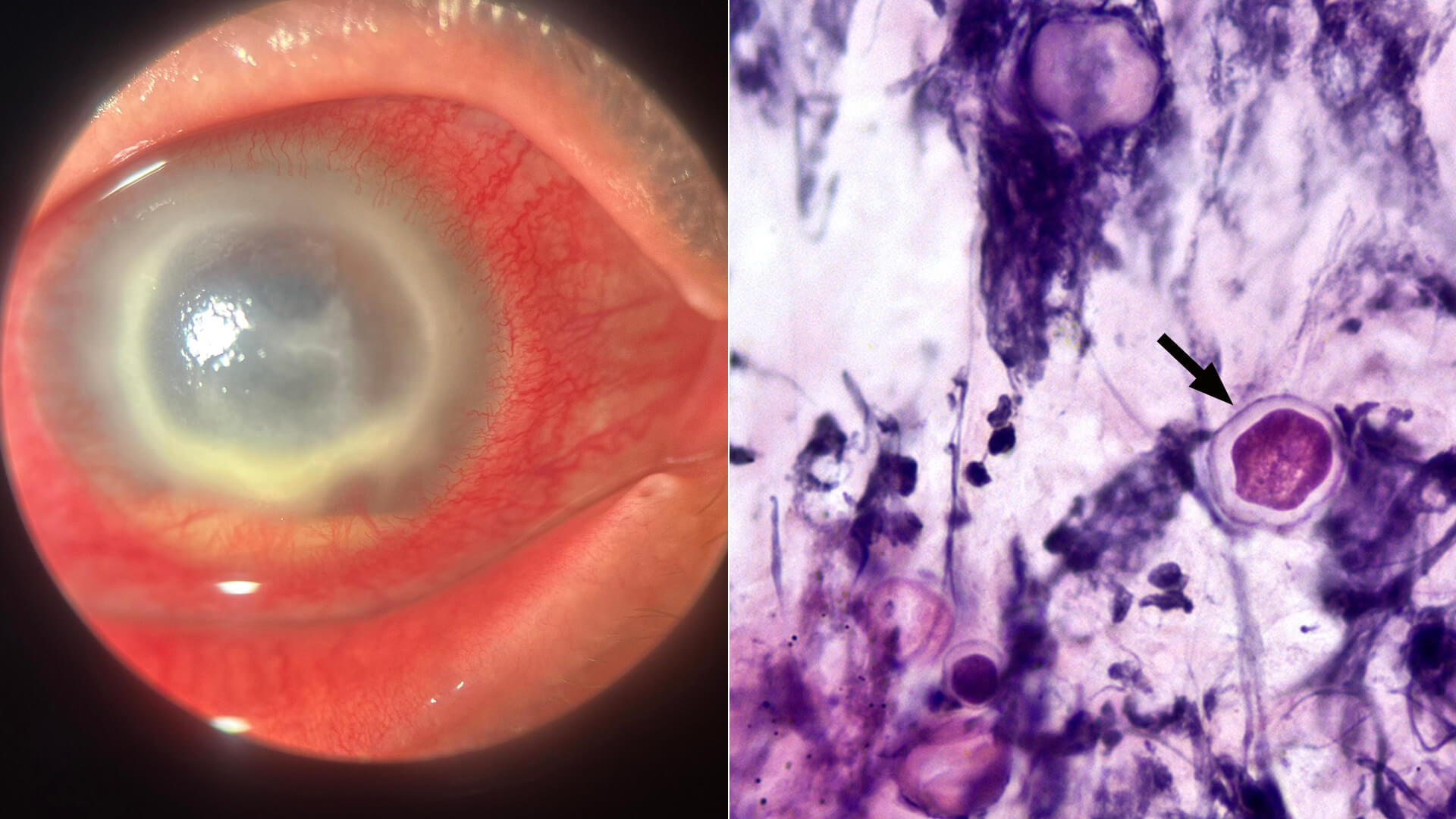 Tatyana Milman, MD, Ocular Pathology