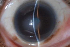 Fuchs' Dystrophy Slit Lamp