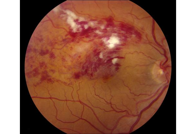 ÙØªÙØ¬Ø© Ø¨Ø­Ø« Ø§ÙØµÙØ± Ø¹Ù âªbranch retinal vein occlusionâ¬â