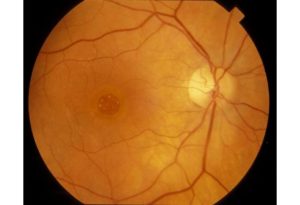 Macular Hole