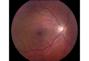 Macular Pucker