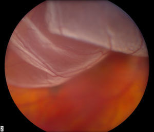 Retinal Detachment - Vitreo-Retinal Consultants