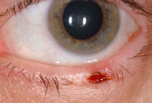 Eyelid Basal Cell Carcinoma Wills Eye Hospital