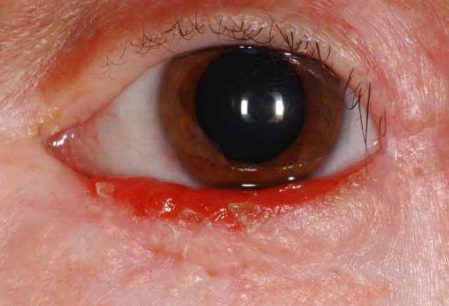 Eyelid Basal Cell Carcinoma Wills Eye Hospital