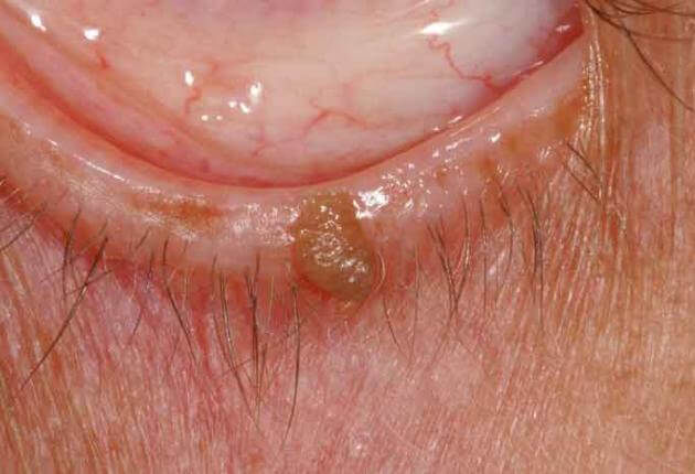 Papilloma lid skin. Squamous papilloma lid