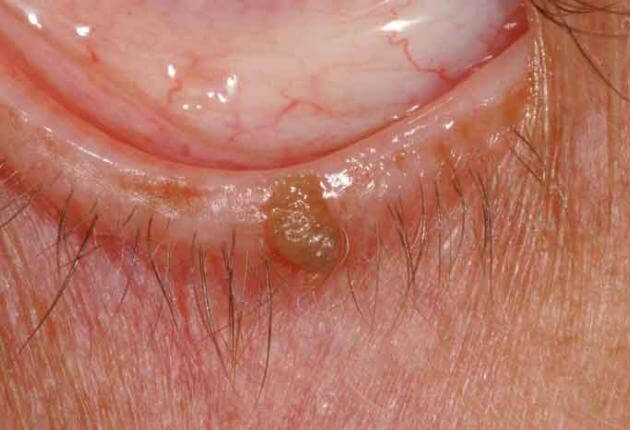 papilloma in)