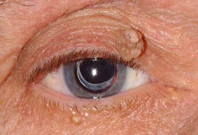 papilloma eyelid