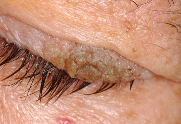 papilloma eyelid