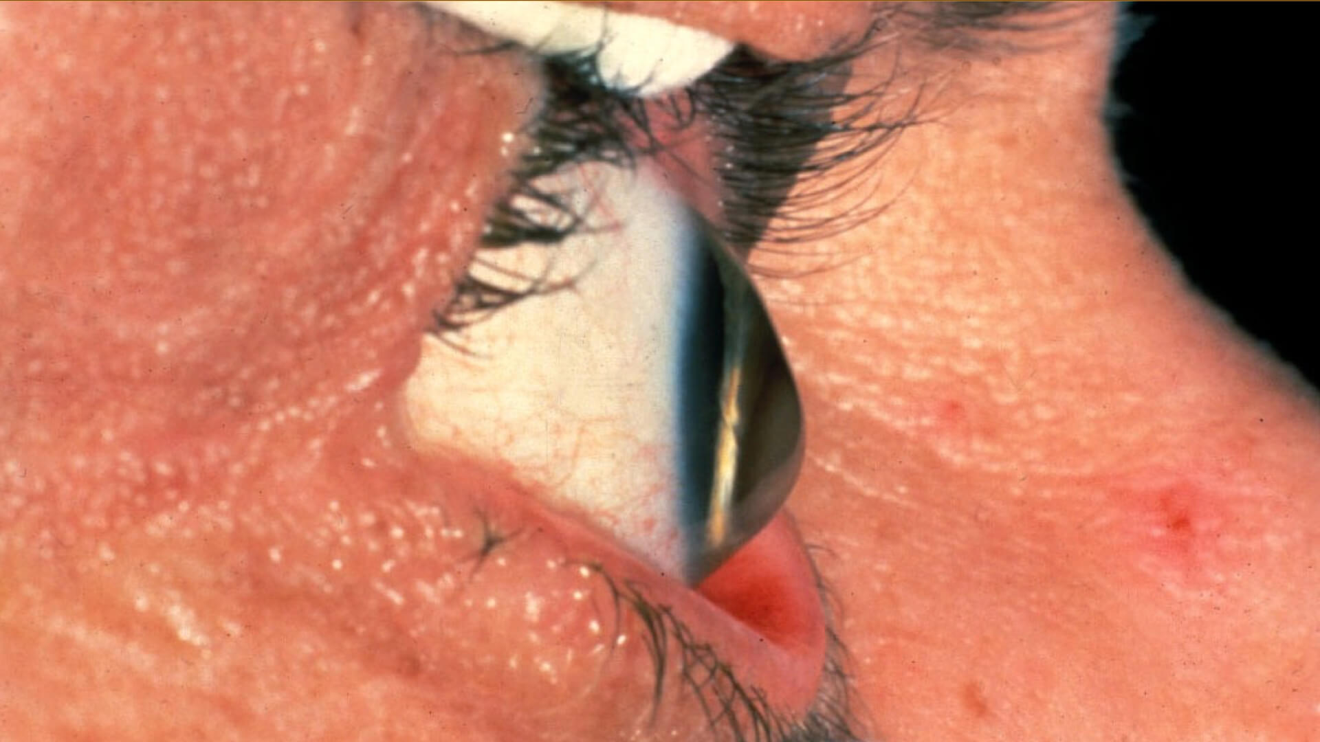 keratoconus