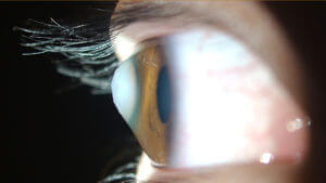 Keratoconus