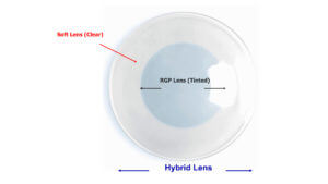 This is a specialty Contact Lens for the treatment of Keratoconus