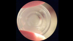Keratoconus Contact Lens