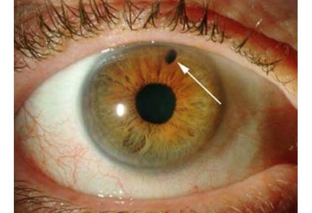 Laser Peripheral Iridotomy | Wills Eye Hospital