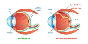 Retinal Detachment