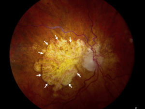 This is a photo of a patient with Age-Relate Macular Degeneration