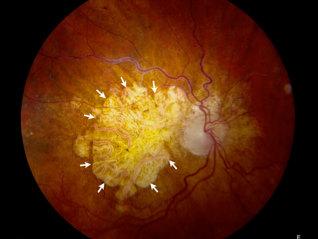 Advanced Macular Degeneration Wills Eye Hospital advanced-macular-degeneration-wills-eye-hospital