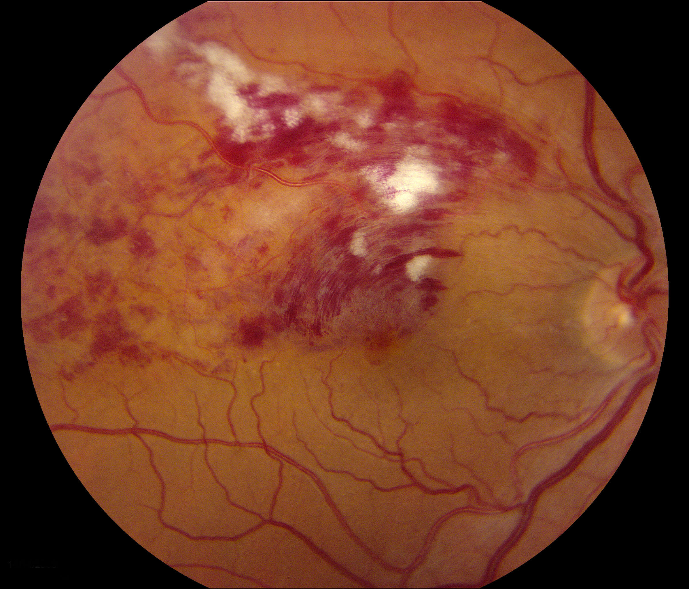 Proliferative Diabetic Retinopathy