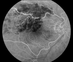 branch retinal vein occlusion 2