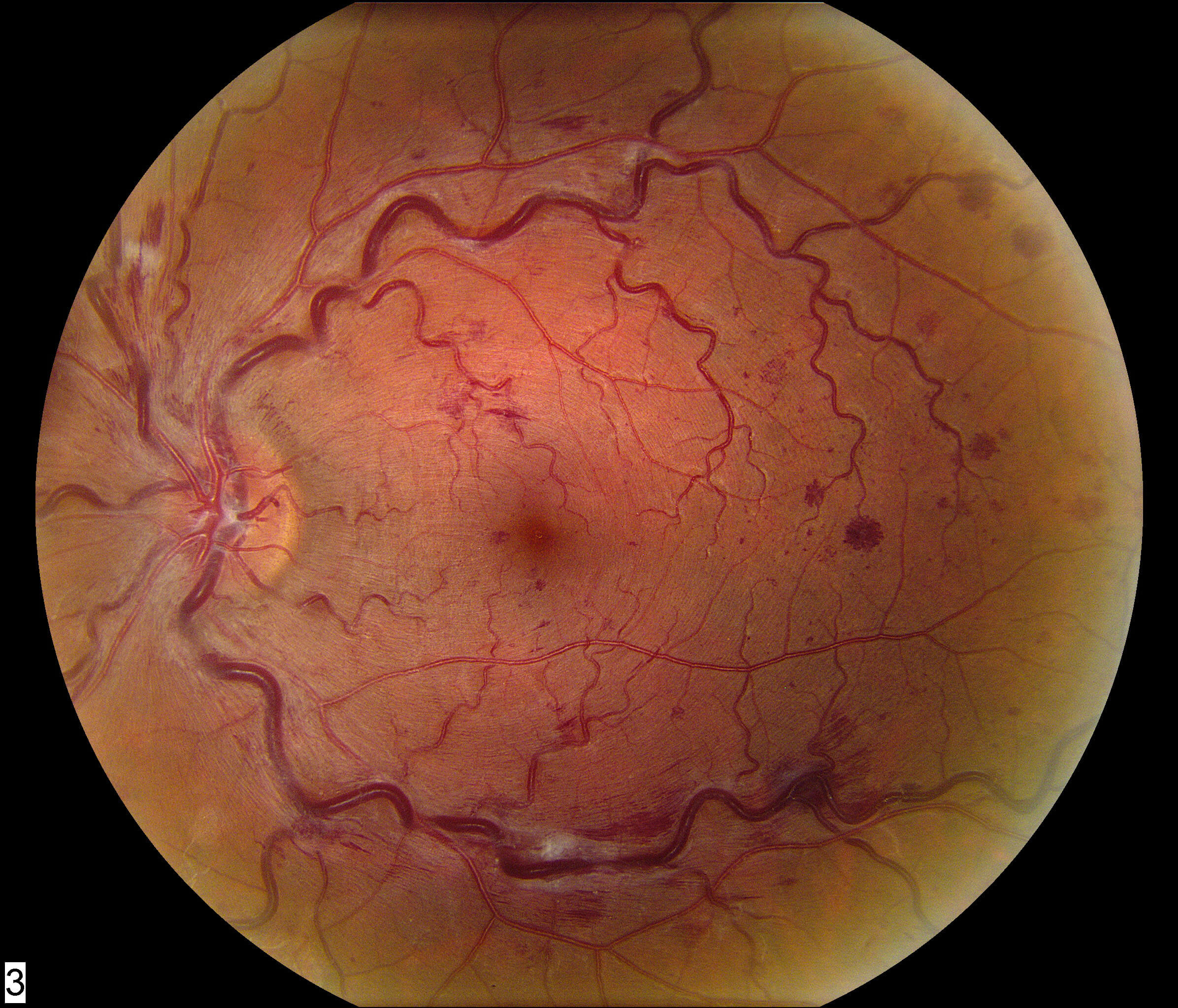 Non-proliferative diabetic retinopathy with macular edema