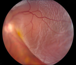 This image is a photo of a patient with a Retinal Detachment