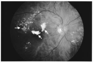 Non-proliferative diabetic retinopathy with macular edema