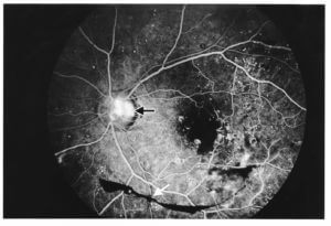 Proliferative Diabetic Retinopathy