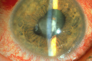 Anterior Uveitis