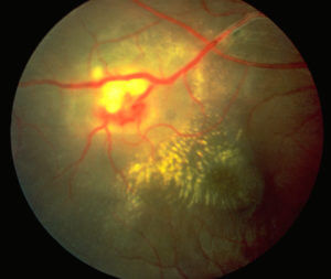 Posterior Uveitis