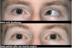 Strabismus before and after correction in an adult