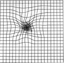 Amsler Grid with Macular Degeneration