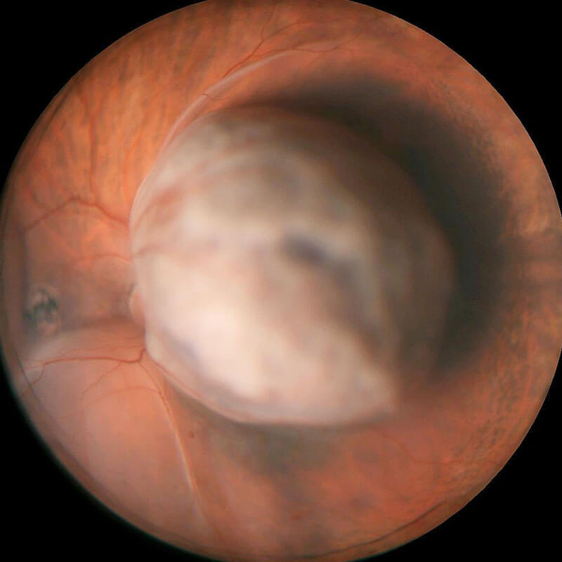 Choroidal Melanoma