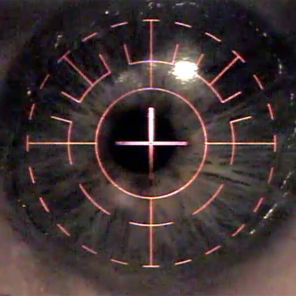 This is an image taken during a LASIK Procedure