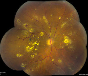 This photo is a patient with Diabetic Retinopathy
