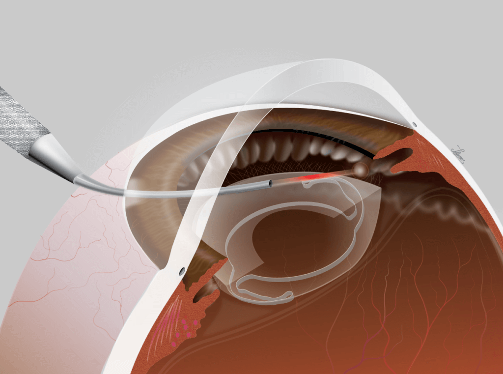 Endoscopic Cyclophotocoagulation (ECP) Wills Eye Hospital