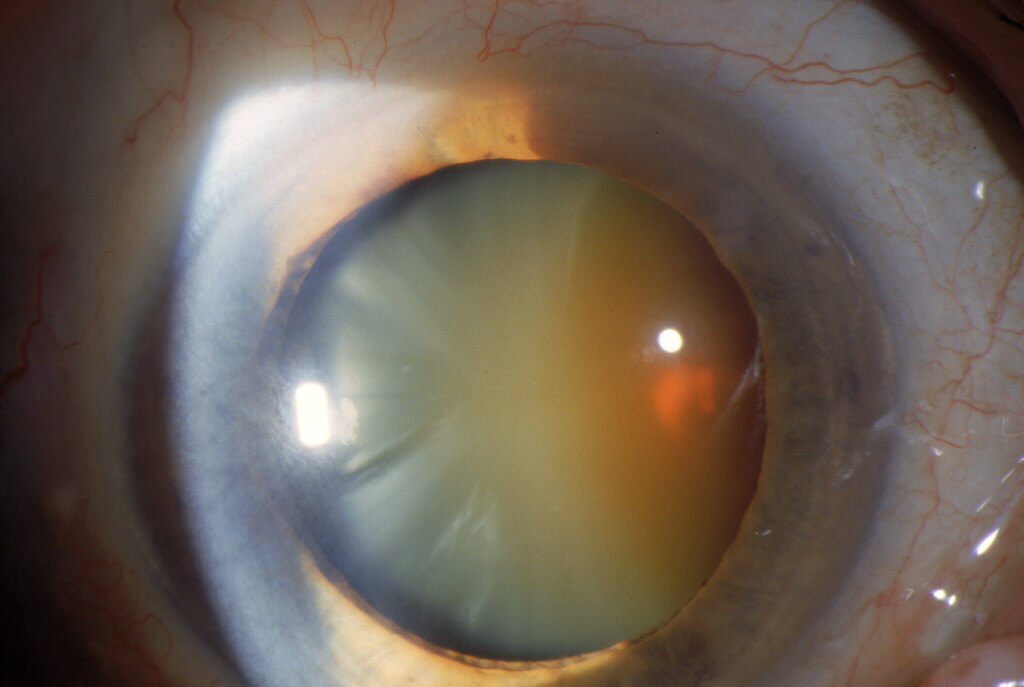 Cataract - Mature Cataract