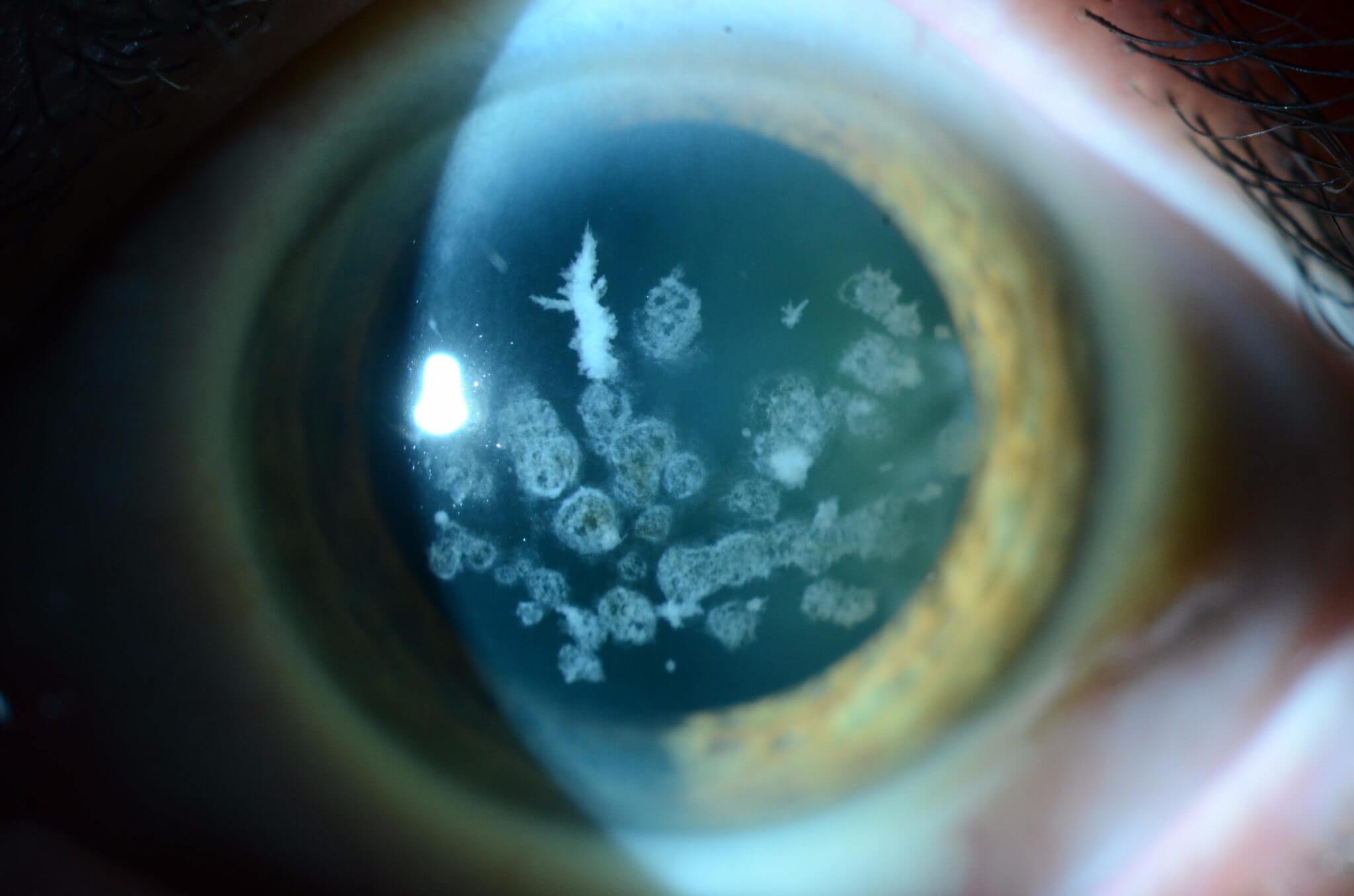 corneal degeneration treatment