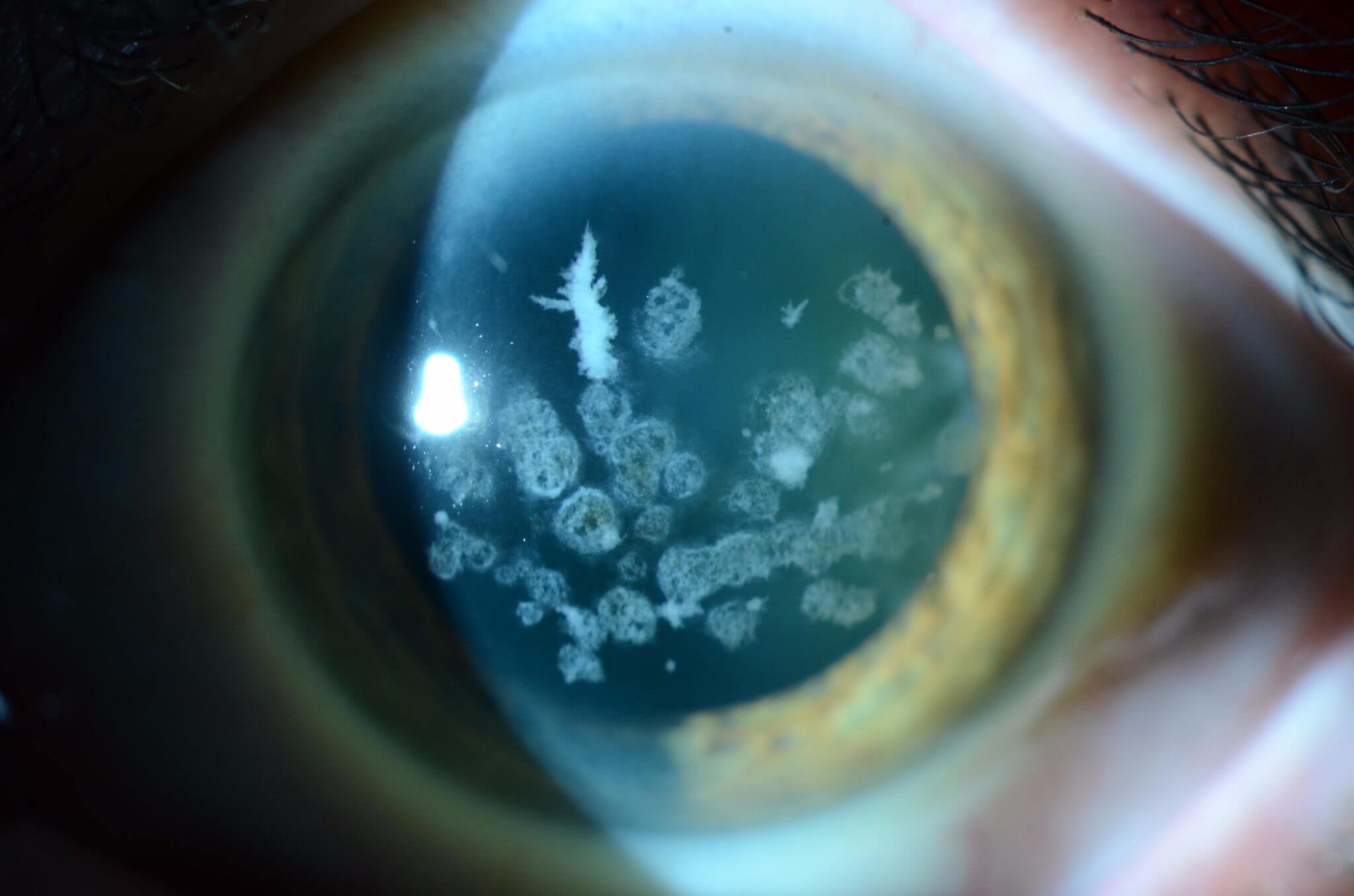 Corneal Dystrophy Wills Eye Hospital