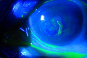 Recurrent Corneal Erosions Wills Eye Hospital