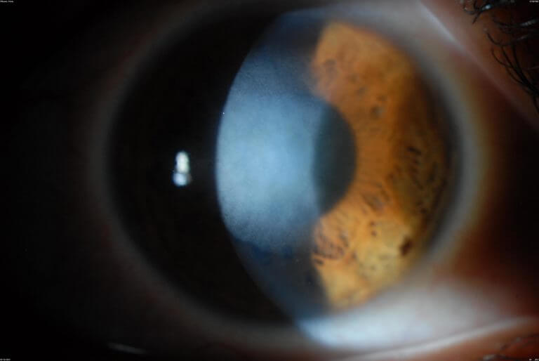 Corneal Dystrophies and Scars Wills Eye Hospital