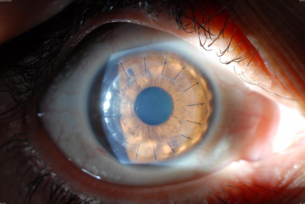 Corneal Transplantation Wills Eye Hospital