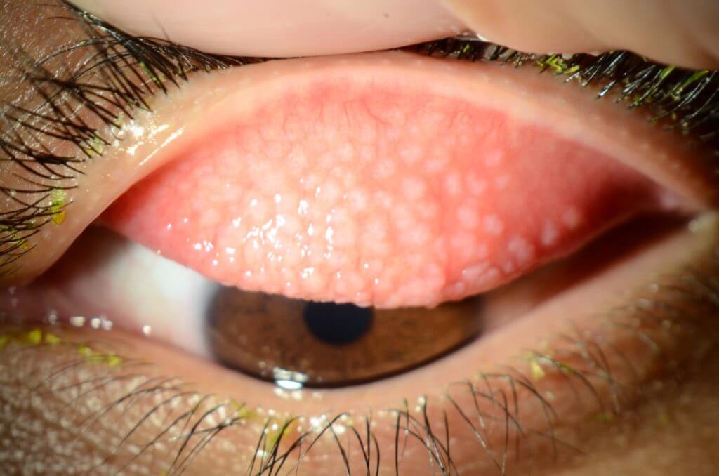 Giant Papillary Conjunctivitis Wills Eye Hospital