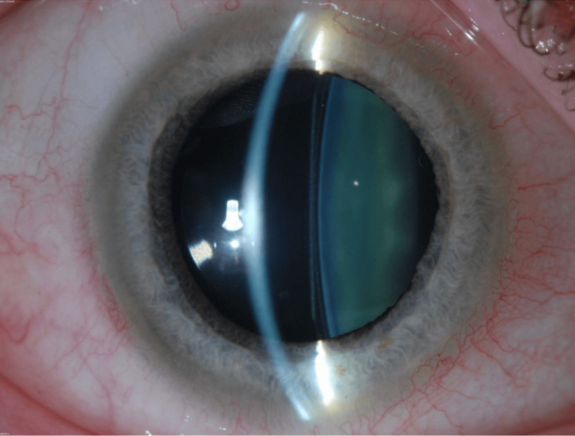 Blazen Uiterlijk tentoonstelling Implantable Collamer Lens (ICL) Surgery | Wills Eye Hospital