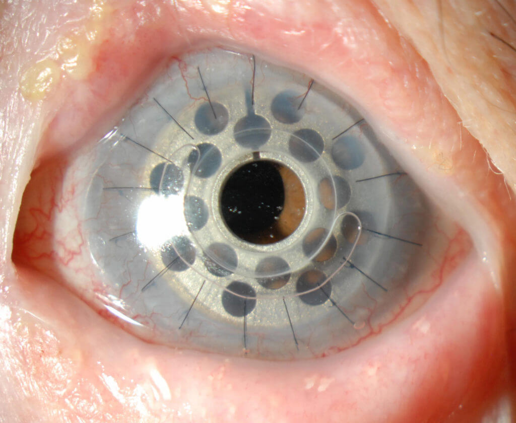 Boston Keratoprosthesis Artificial Corneal Transplant Wills Eye