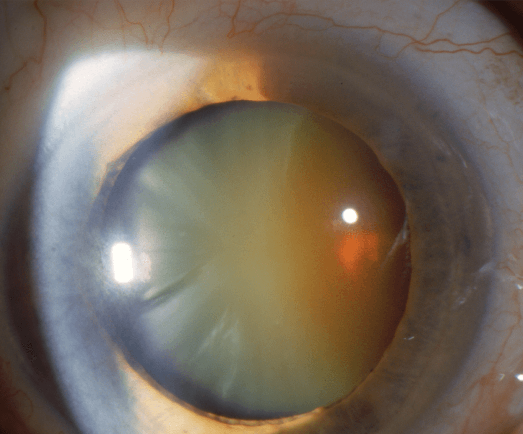 Cataract - Mature Cataract