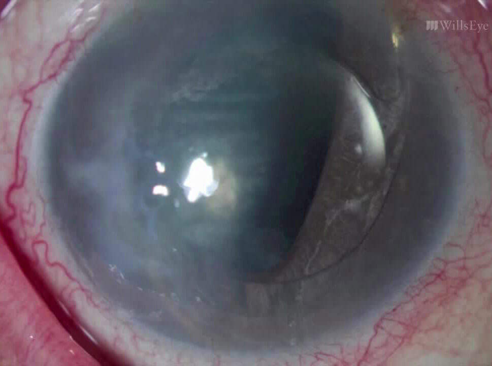 icd 10 code for dislocated intraocular lens left eye