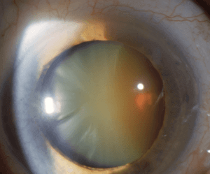 Cataract Surgery