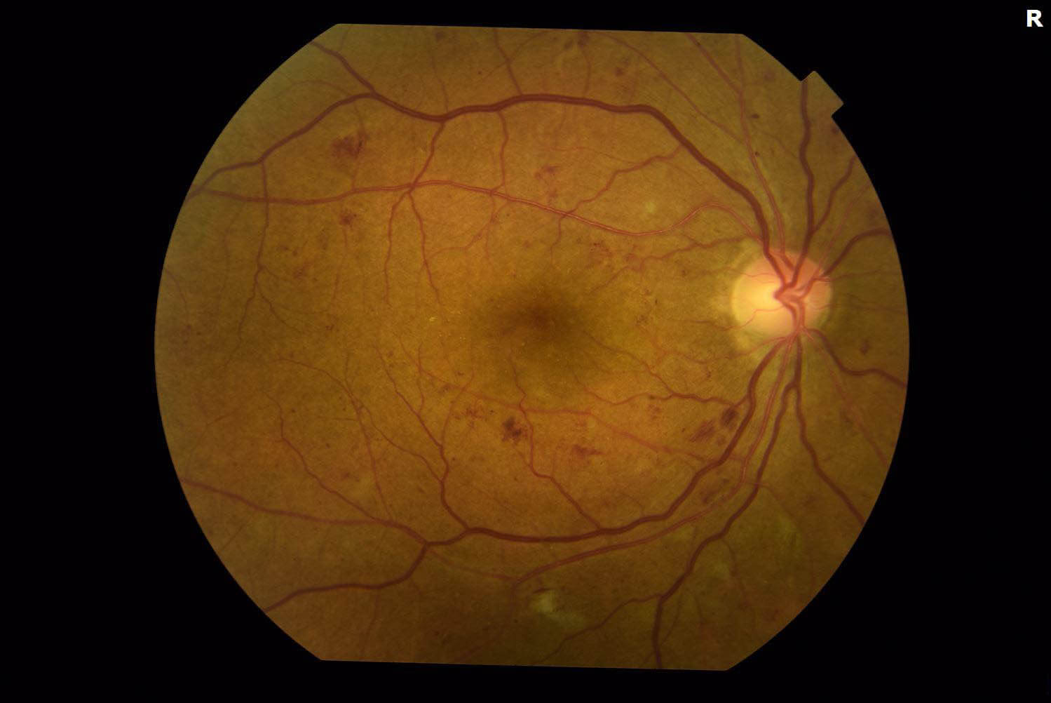 Non-proliferative diabetic retinopathy with macular edema