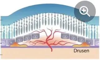 Age Related Macular Degeneration