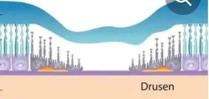 Macular Degeneration